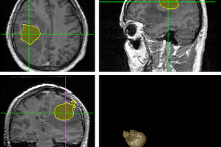 Automated segmentation of Brain Tumors