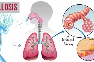 Aspergillosis — Know It All!