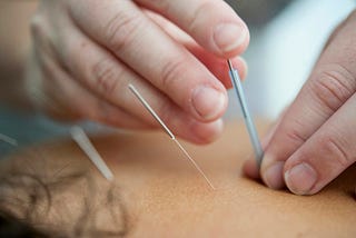 Acupuncture Treatment For Pain
