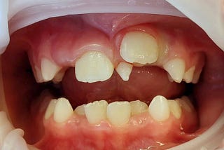 Malocclusion Extra Teeth Growing in Gums: Treatment and Prevention