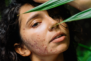 8 Ways to Clear Acne