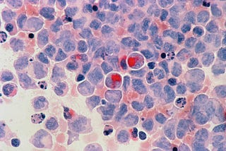 Microscope image of leukemia malignant cells.