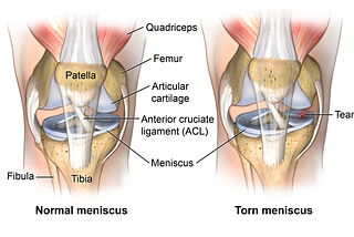 Meniscus Repair or Meniscectomy/ meniscus partial excision/ meniscus trimming: What all one should…