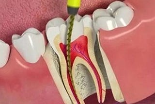 What is Root Canal Treatment and its Complications?