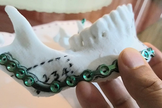 3D-Printed jaw model for Reconstruction surgery