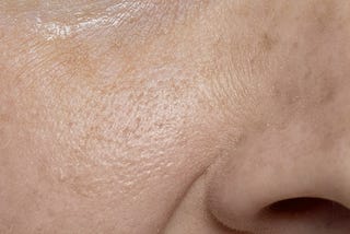 Everything One Needs To Know About Open Pores