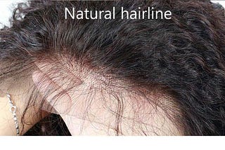 natural hairline