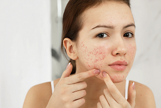 5 Best Inexpensive Acne Products of 2023