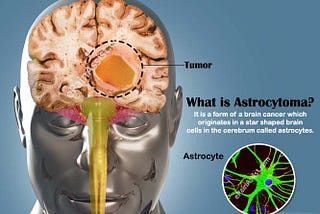 Astrocytoma — Know It All!