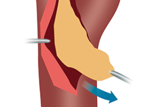 How to Diagnosis Carotid Endarterectomy