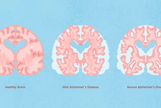 What is Alzheimer’s?