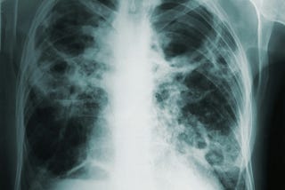 Surviving a Life-Threating Pulmonary Embolism. 3 Tips That Can Save Your Life.