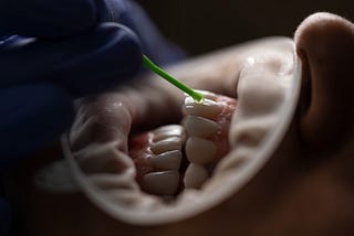 How Long Can You Keep Your Teeth with Periodontal Disease?