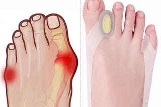 ashomie-new-generation-toe-separator-toe-corrector-toe-spacers-for-women-can-be-adjusted-can-be-worn-1