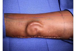 Growing An Ear On A Forearm With Autologous Cartilage