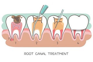 Endodontics or Root Canal Treatment in Pitampura