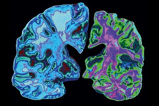 Brain Technologies and Alzheimer’s Disease