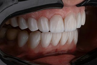 Close up of bottom and top rows of a set of teeth.