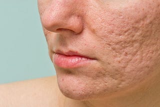 Get Rid of Acne Scars: Effective Ways to Reduce and Remove Them