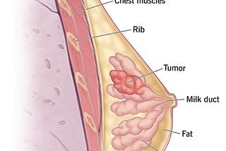 What is breast cancer?