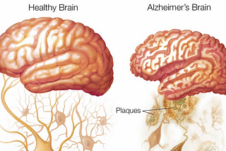 Stem Cells vs. Alzheimer’s