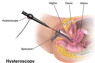 Understand Why Hysteroscopy is Done Before IVF