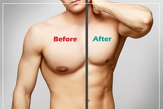 Enlarged Breast in Men — Gynecomastia