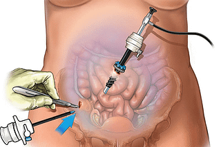 Laparoscopic Urology Surgery | Dr. Ashish Saini