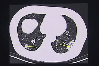 Chest CT Scans As An Alternative To Test Kits To Diagnose COVID-19 — London TV