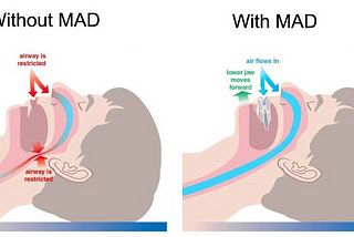 CPAP ALTERNATIVES FOR MILD-MODERATE OBSTRUCTIVE SLEEP APNEA AND SNORING