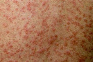 My Thoughts on the Measles Outbreak in England