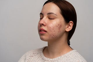 Home Remedies To Get Rid Of Acne