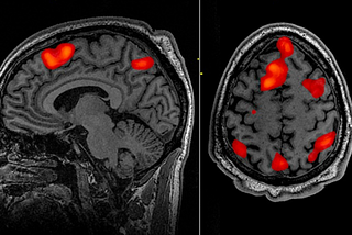 Extending the Understanding of Schizophrenia with AI