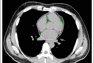 Automatsko mjerenje volumena epikardijalne masti — što računala znaju o vašem kardiovaskularnom…