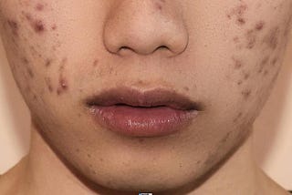 Dark spot home remedies