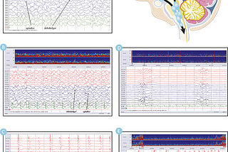 Brain Activity During Coma: The Process of Brain Wave Change and Neuromonitoring