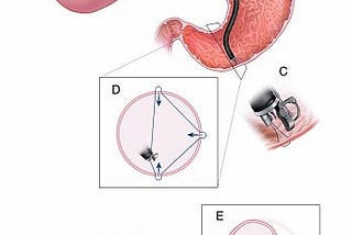 The Endoscopic Sleeve Gastroplasty — Batash Medical MD