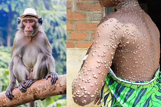Monkeypox: What You Need to Know