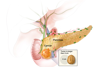 Which cancer is known as the silent killer?