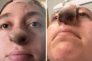 Una joven perdió la nariz por el mordisco de un perro: ahora ella también tiene una nariz de perro