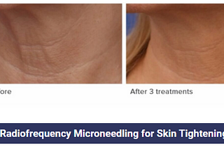 Discover the Magic of Microneedling with PRP Highlands NC: Your Path to Youthful Skin