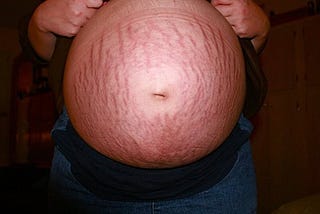 Stretch marks in pregnancy causes, prevent, treatment