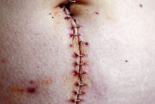 Hiding Scars or Revealing Wounds?