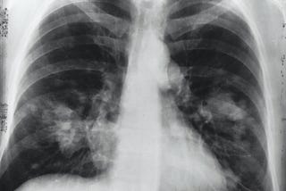 Lung Сancer Risk in Women Who Breathe Wood Smoke. Rethinking the Sister Study