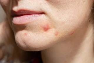 Blood Pimples on Face: What You Need to Know and How to Handle Them?