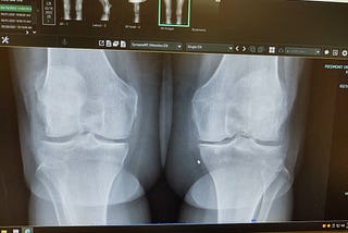 Knee Replacement Surgery, Part 1