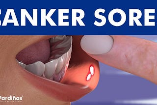 Canker sore — Know It All!