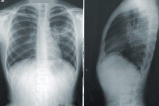 Pneumonia Detection completed by a CNN