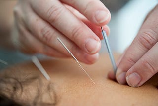 Therapist placing needles over a woman’s back.
