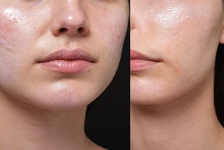 Can Microchanneling Reduce Acne Scars?